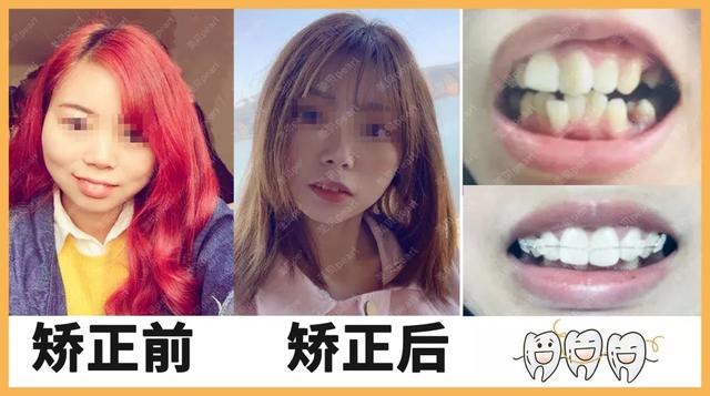 我俩戴牙套!而且在吧! 第21张