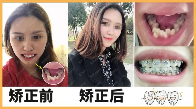 我俩戴牙套!而且在吧! 第20张