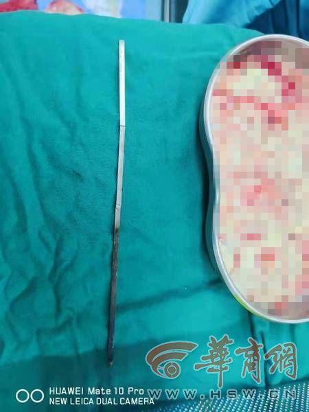 西安昨天发生了什么伤西安昨天发生了什么伤「西安28岁小伙酒后吞进烤肉铁签，医生紧急联系心胸外科会诊」  第3张